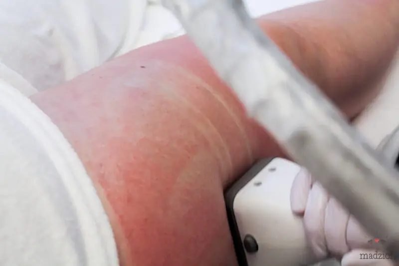 zabieg-modente-w-vivien-clinic-w-krakowie-21