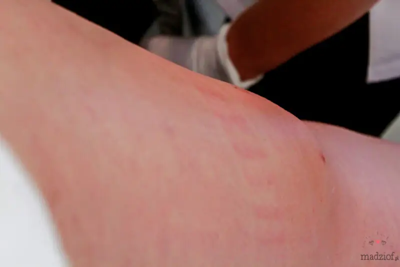 zabieg-modente-w-vivien-clinic-w-krakowie-24