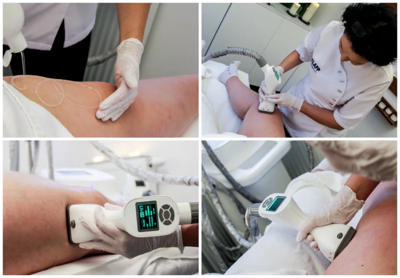 zabieg-modente-w-vivien-clinic-w-krakowie-kolaz1